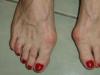 1627_Hallux_valgus.jpg