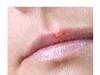 virusul_herpes_simplex.jpg